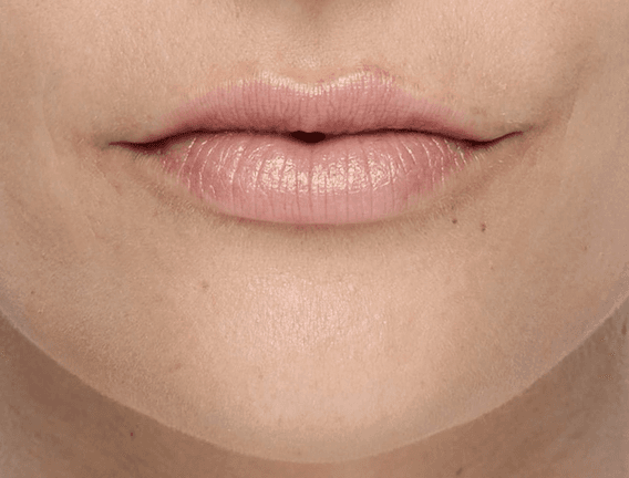 Lips after Restylane KYSSE treatment