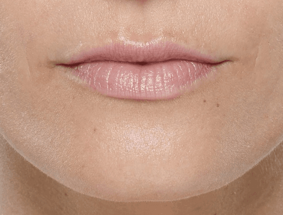 Lips before Restylane KYSSE treatment