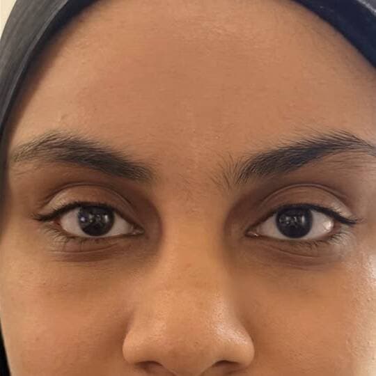 Under-eye area after Teosyal Redensity 2 treatment