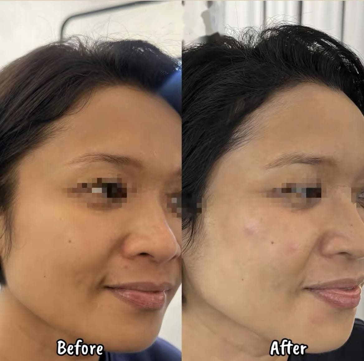Before and after — improved skin texture and radiance