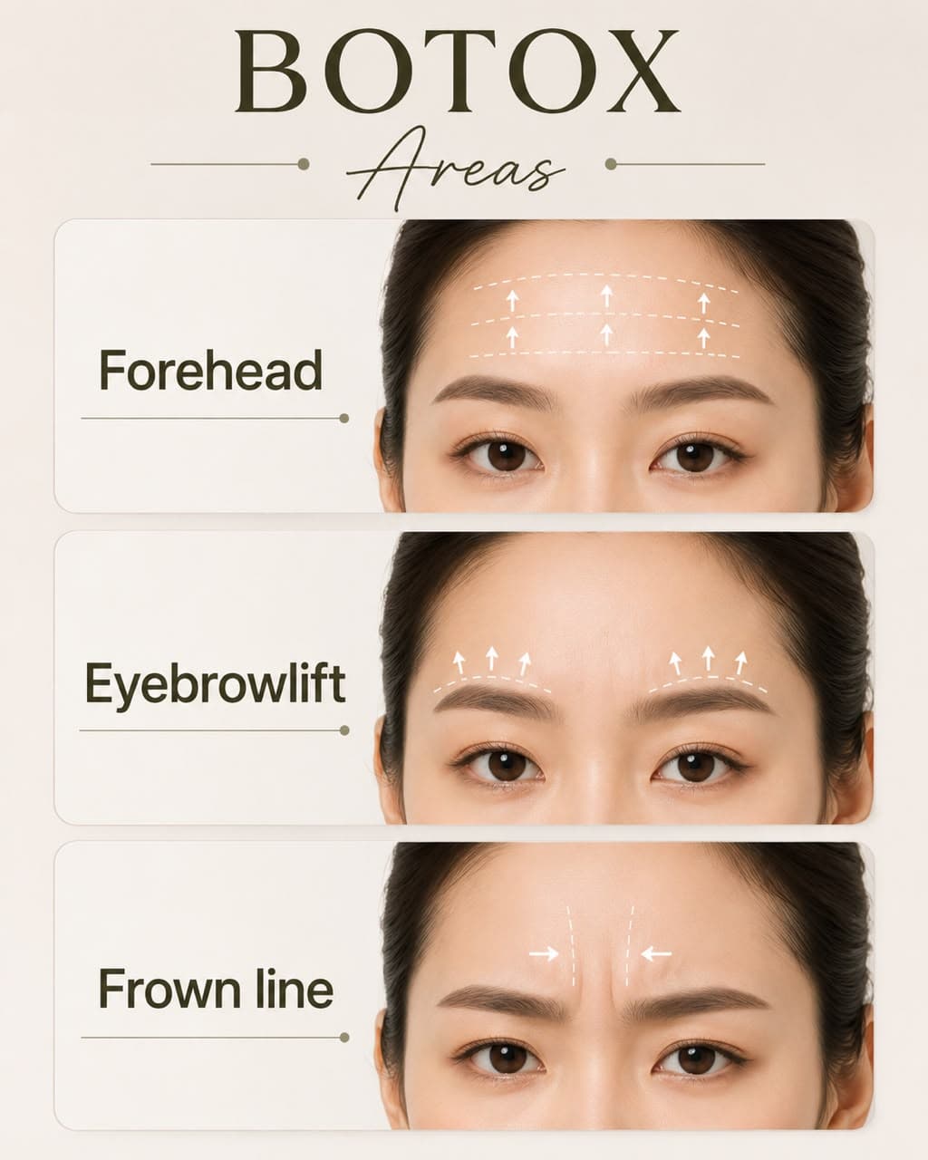 Botox areas — forehead, eyebrow lift and frown line